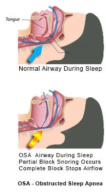 Obstructive Sleep Apnea - normal and blocked airflow