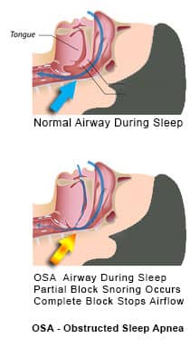 Obstructive Sleep Apnea - normal and blocked airflow